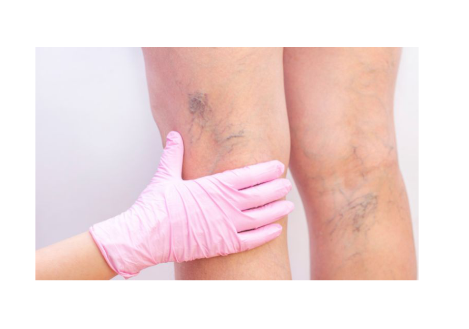 Treatment of Varicose veins